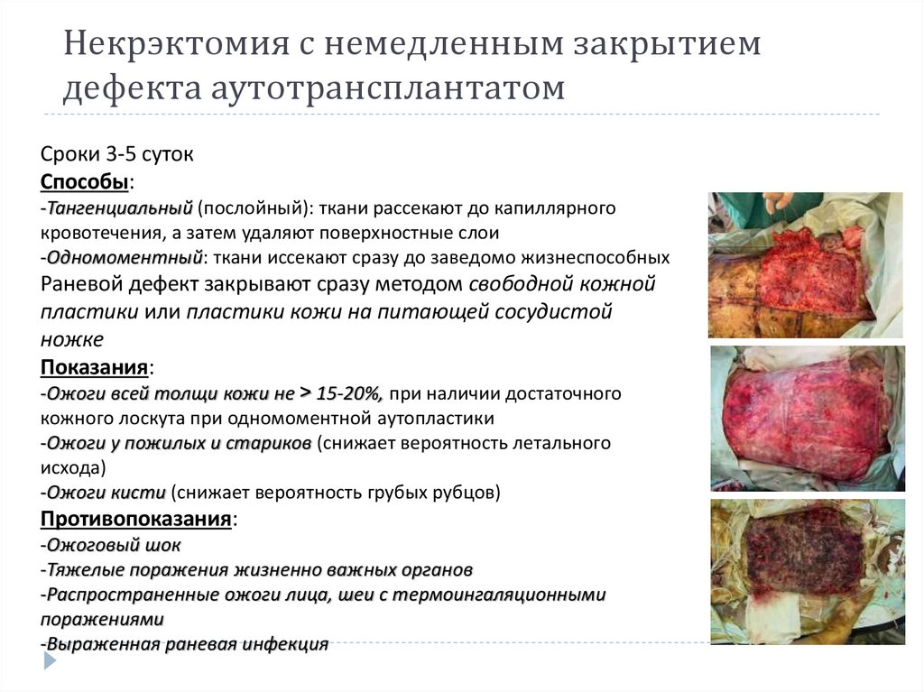 Некрэктомия с немедленным закрытием дефекта аутотрансплантатом