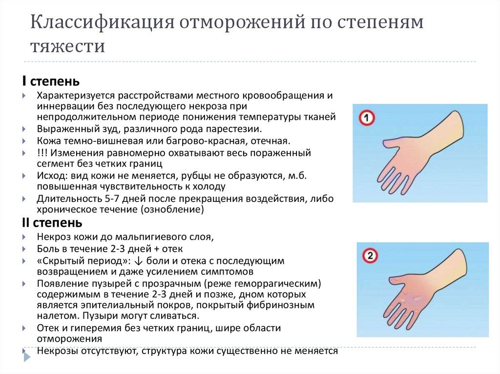 Классификация отморожений по степеням тяжести