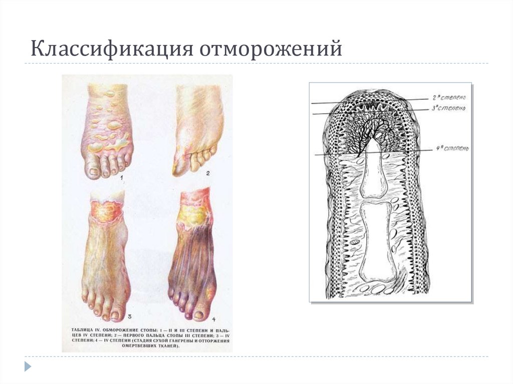 Классификация отморожений