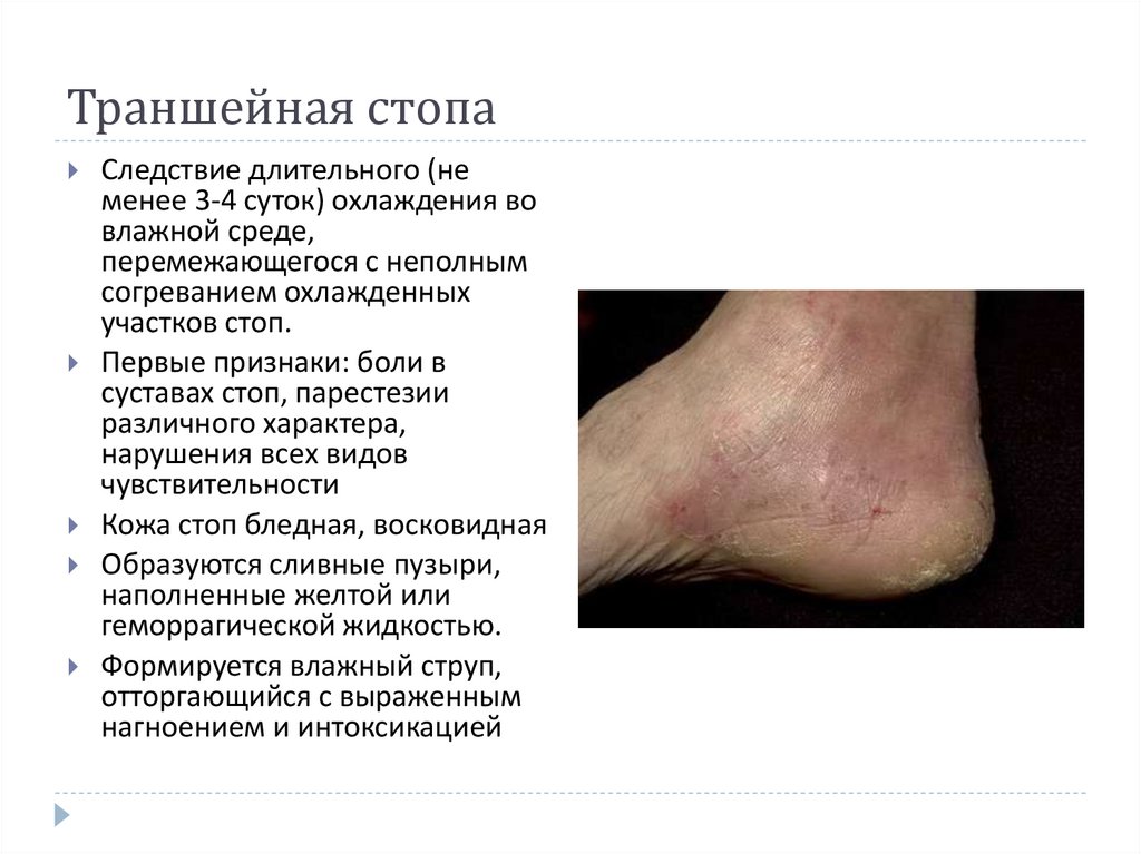 Траншейная стопа