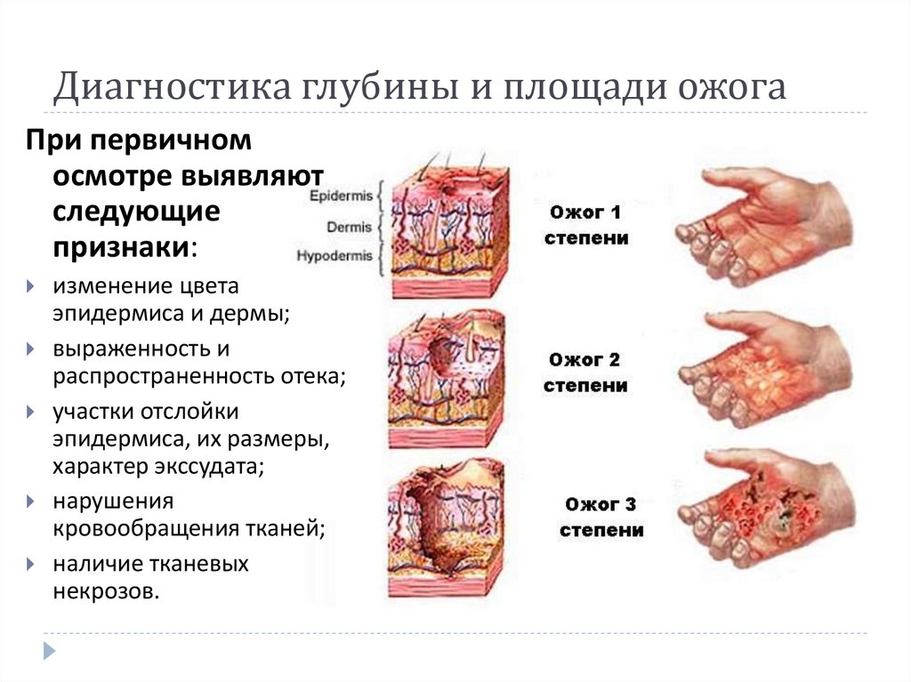 Диагностика глубины и площади ожога