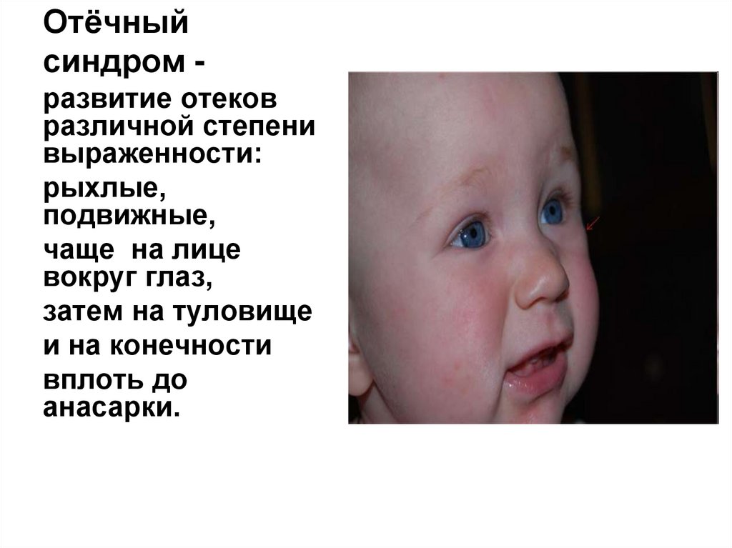 Отёчный синдром -