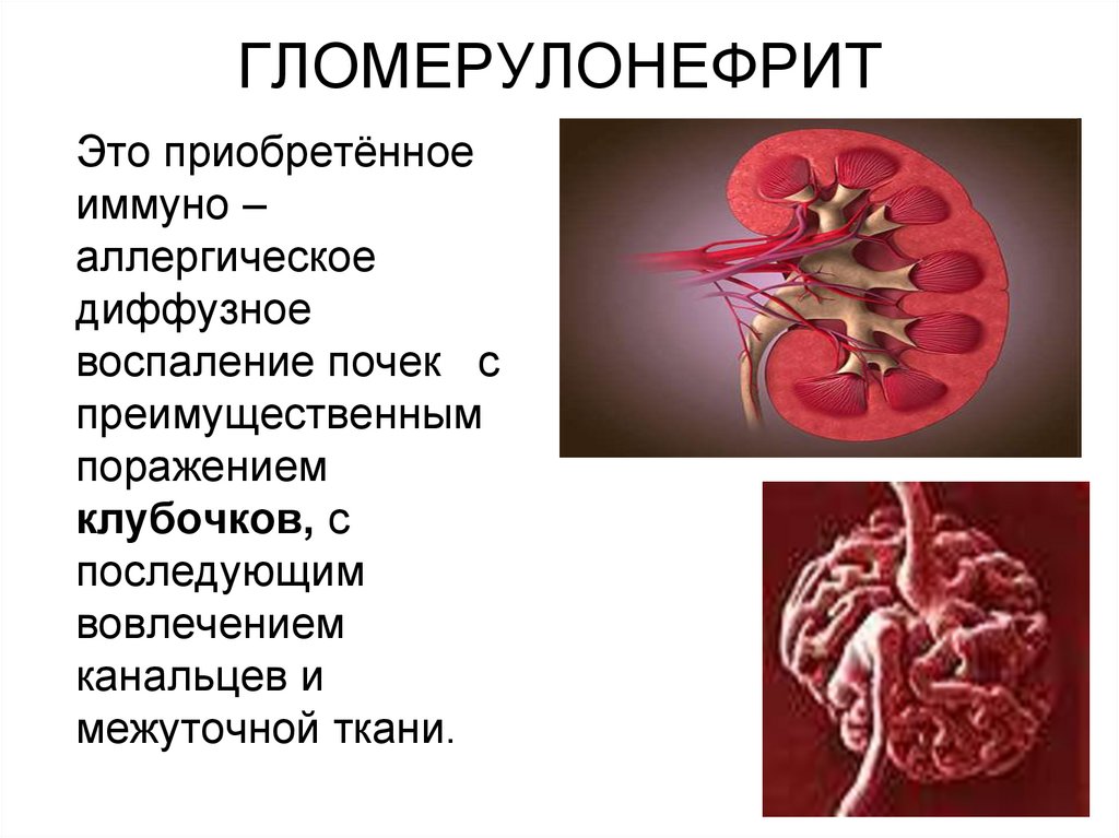 ГЛОМЕРУЛОНЕФРИТ