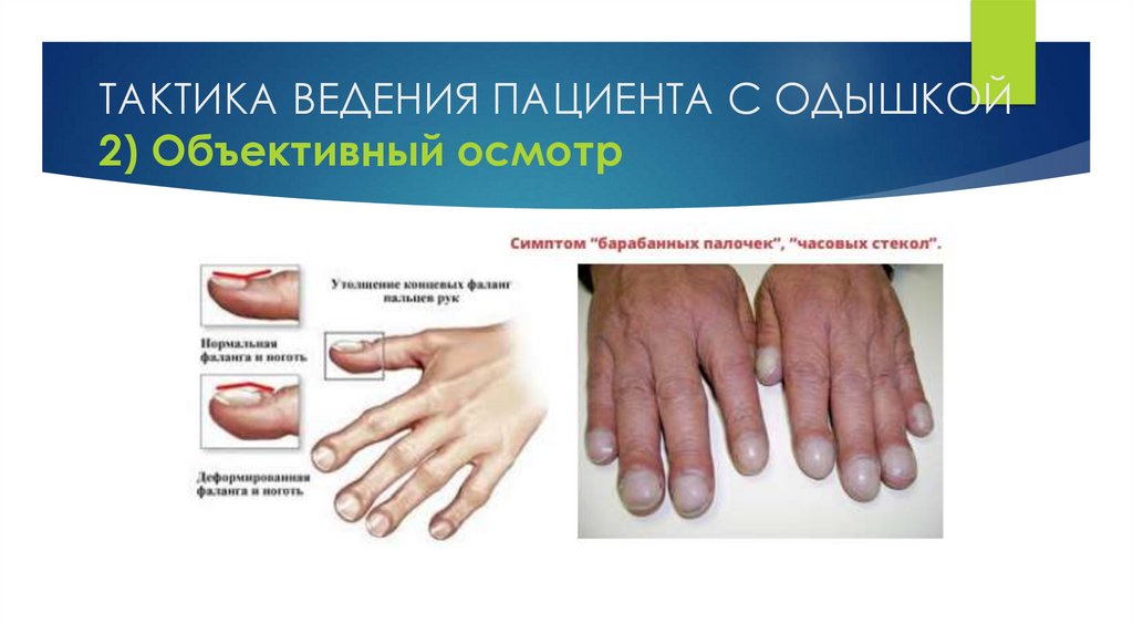 ТАКТИКА ВЕДЕНИЯ ПАЦИЕНТА С ОДЫШКОЙ 2) Объективный осмотр