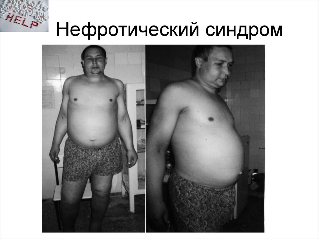 Нефротический синдром