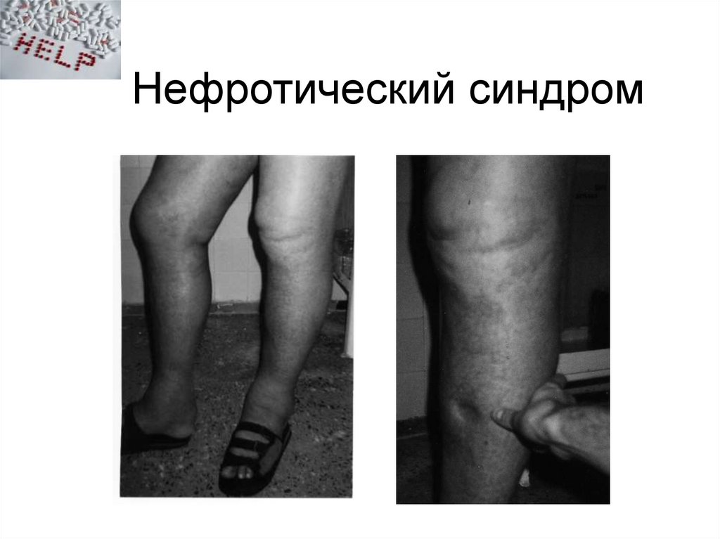 Нефротический синдром