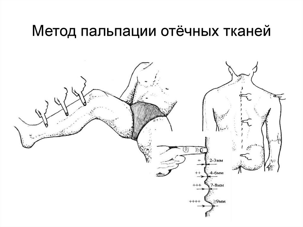 Метод пальпации отёчных тканей