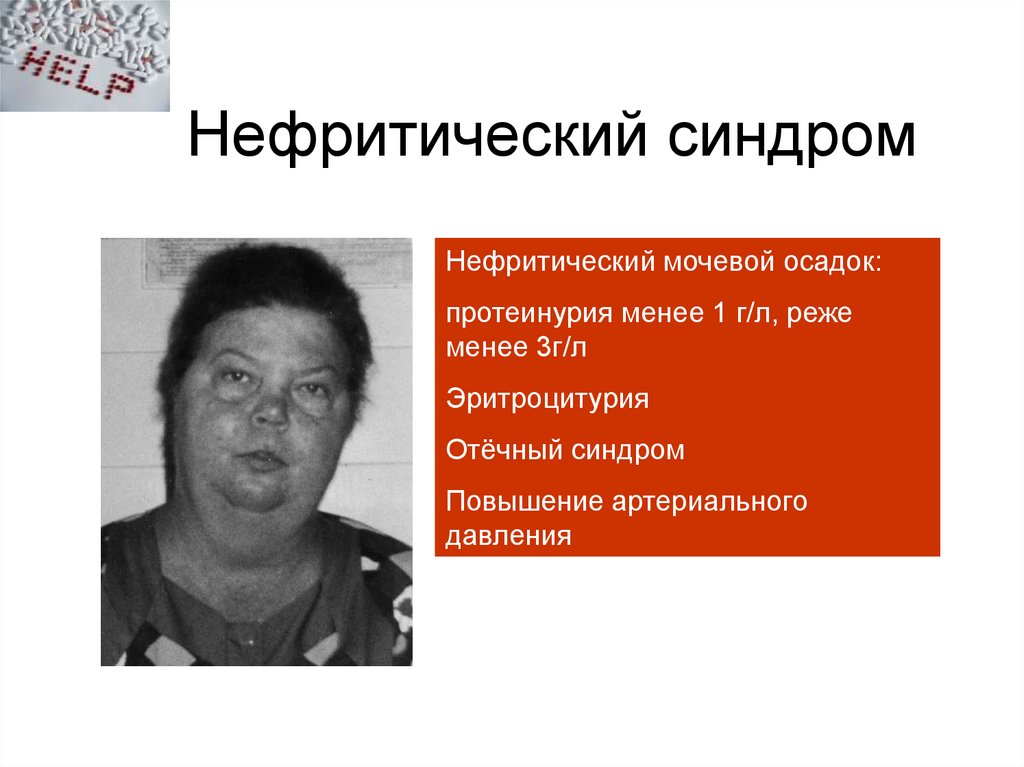 Нефритический синдром