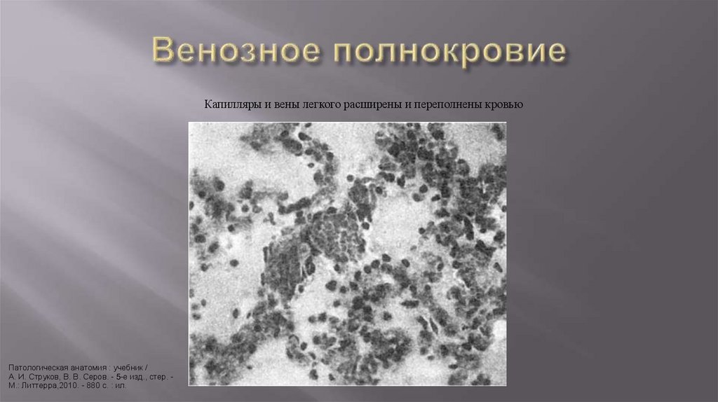 Венозное полнокровие