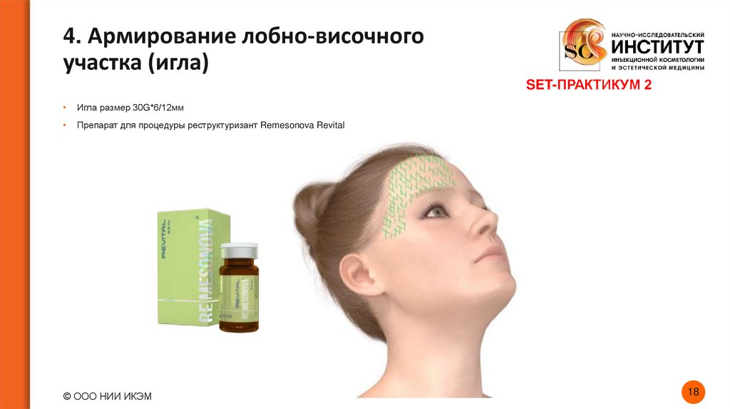 4. Армирование лобно-височного участка (игла)