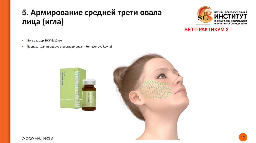 5. Армирование средней трети овала лица (игла)