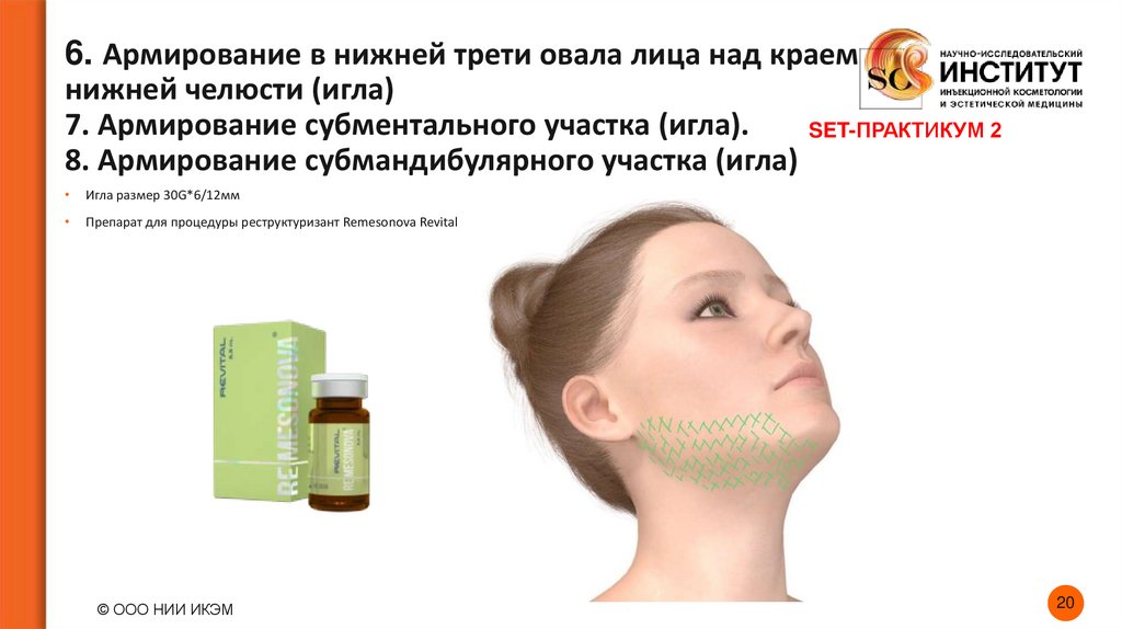 6. Армирование в нижней трети овала лица над краем нижней челюсти (игла) 7. Армирование субментального участка (игла). 8.
