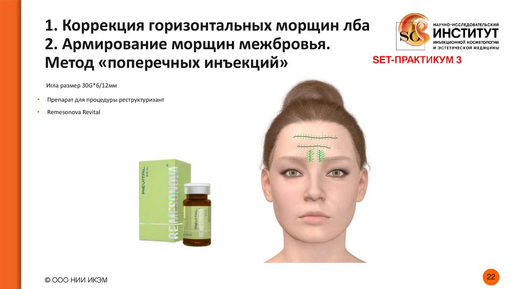 1. Коррекция горизонтальных морщин лба 2. Армирование морщин межбровья. Метод «поперечных инъекций»