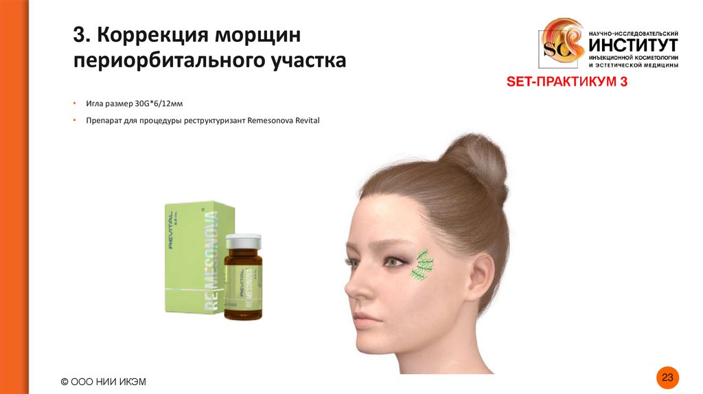 3. Коррекция морщин периорбитального участка