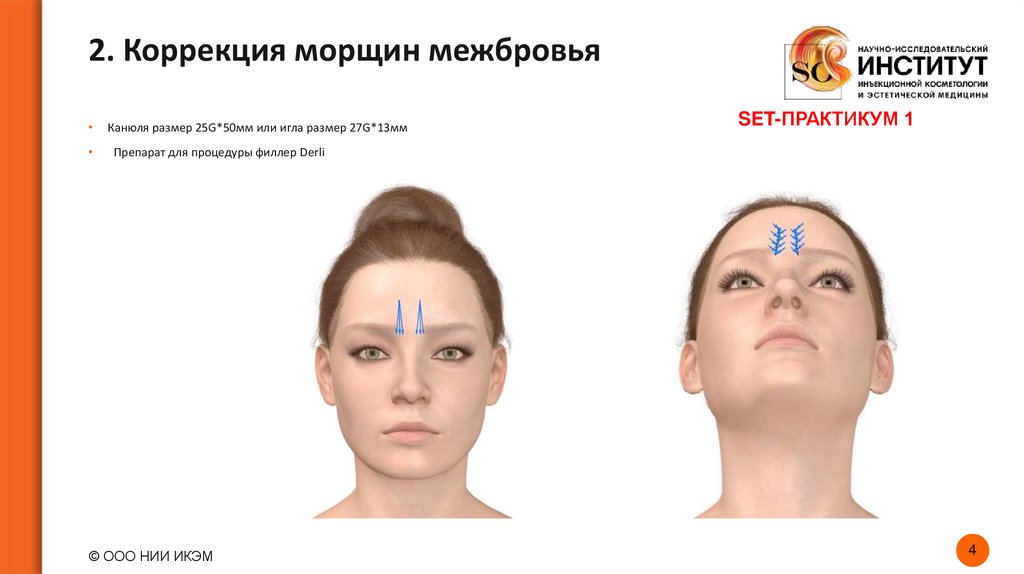 2. Коррекция морщин межбровья