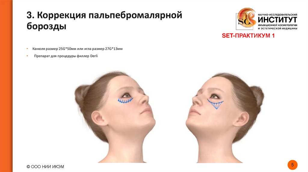 3. Коррекция пальпебромалярной борозды