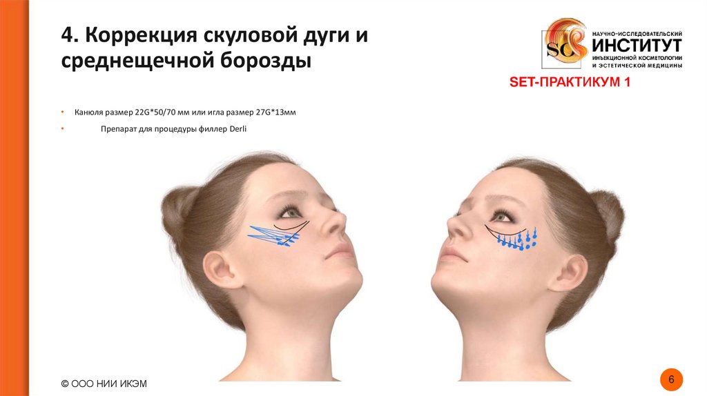 4. Коррекция скуловой дуги и среднещечной борозды