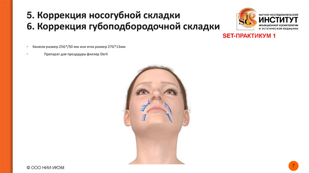 5. Коррекция носогубной складки 6. Коррекция губоподбородочной складки