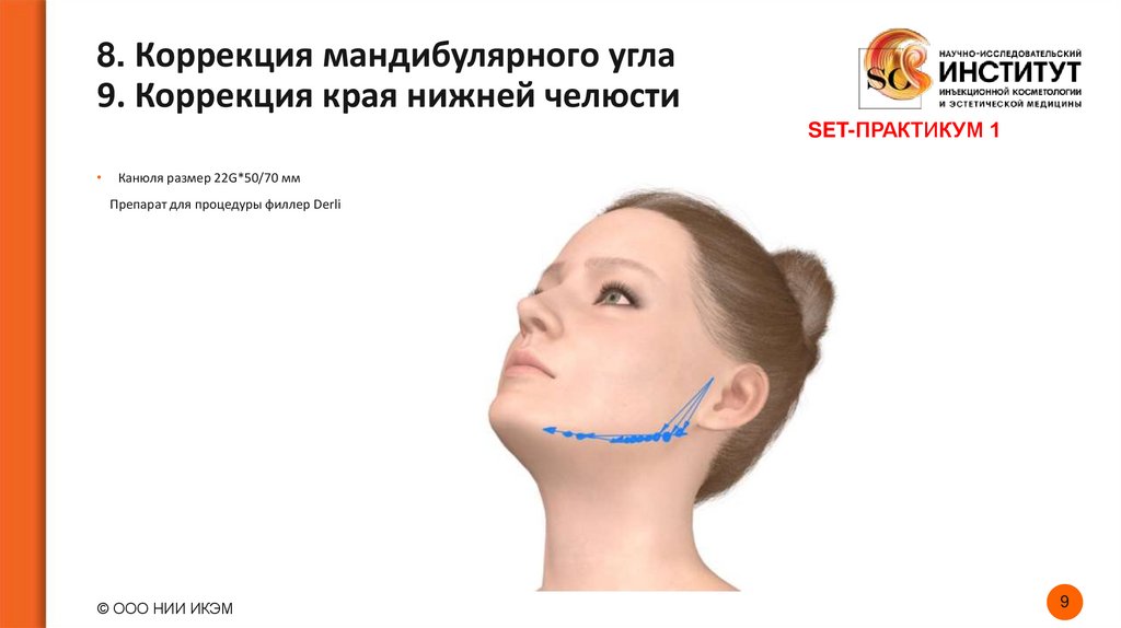 8. Коррекция мандибулярного угла 9. Коррекция края нижней челюсти