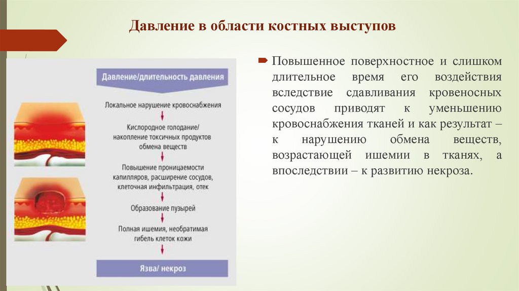 Давление в области костных выступов