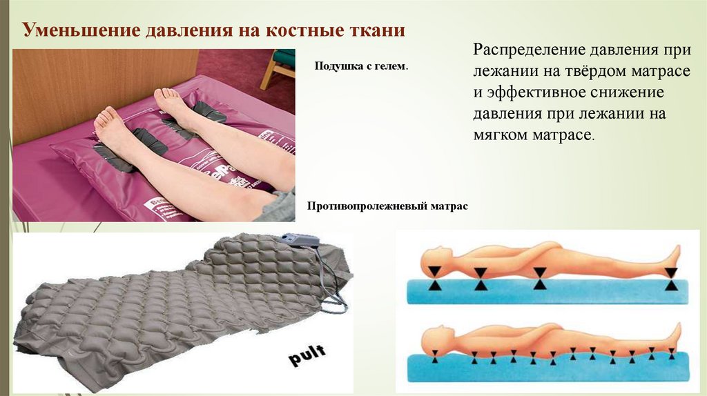 Уменьшение давления на костные ткани