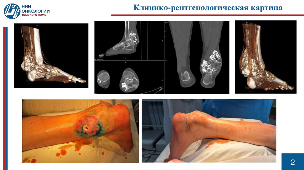 Клинико-рентгенологическая картина