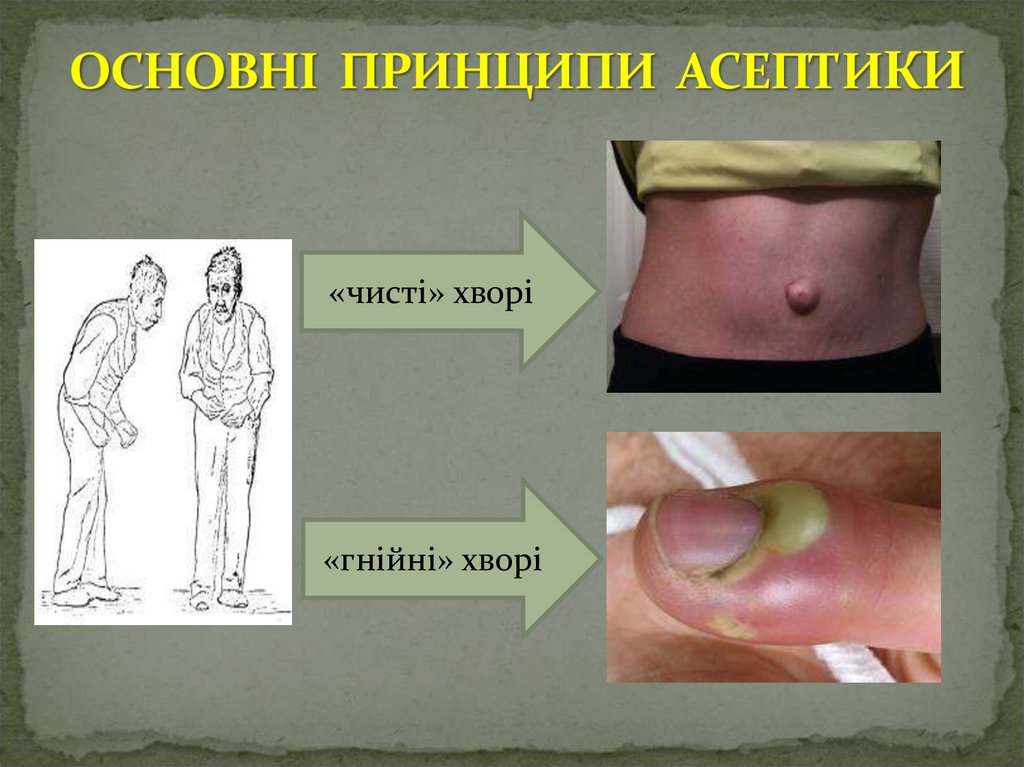 ОСНОВНІ ПРИНЦИПИ АСЕПТИКИ