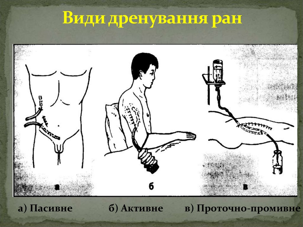 Види дренування ран