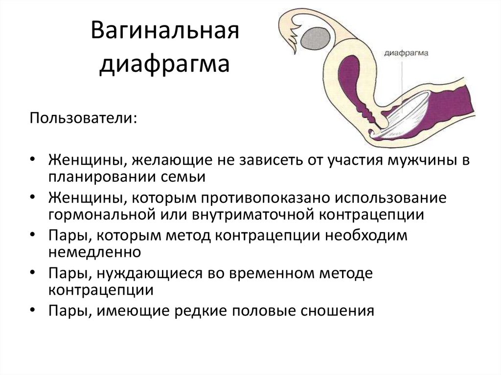 Вагинальная диафрагма