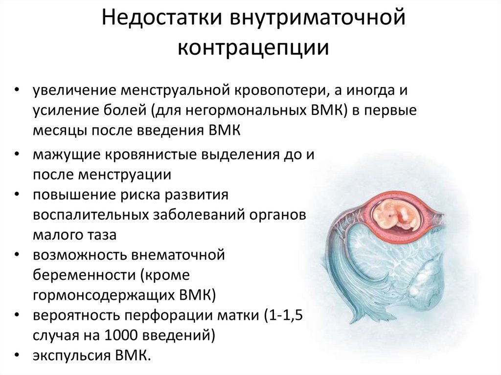 Недостатки внутриматочной контрацепции