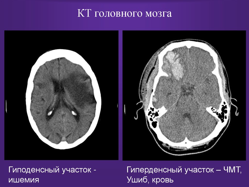 КТ головного мозга