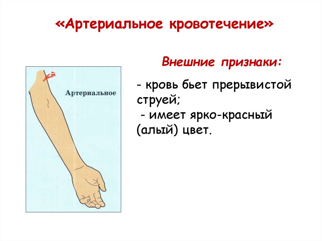 «Артериальное кровотечение»