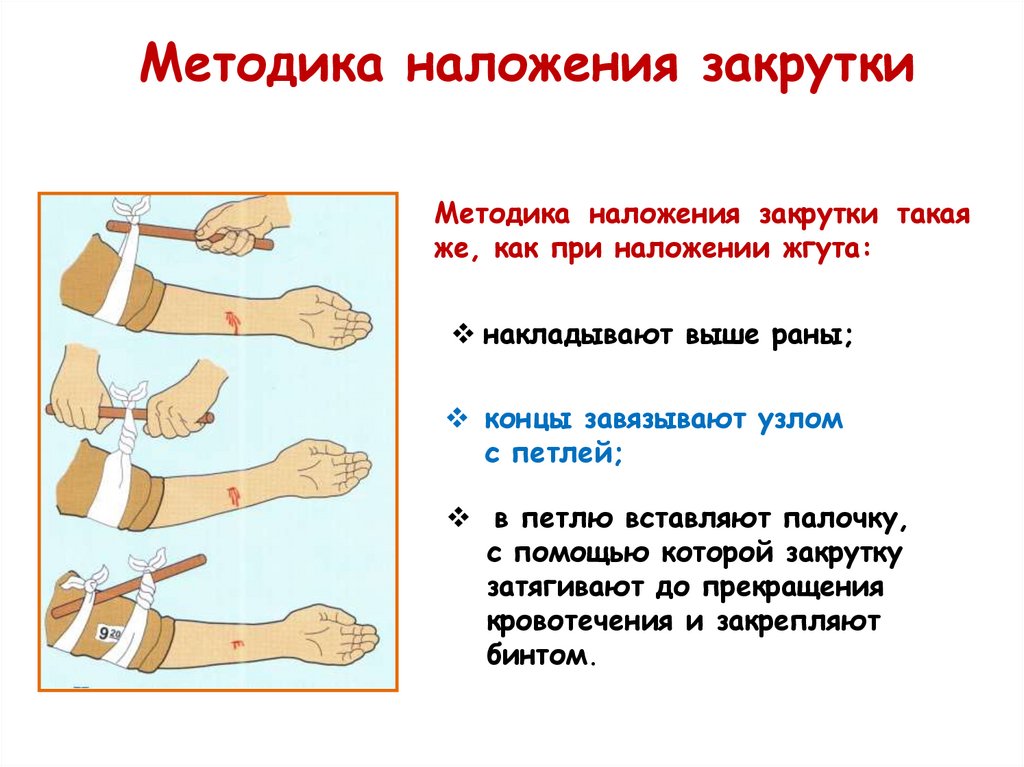 Методика наложения закрутки