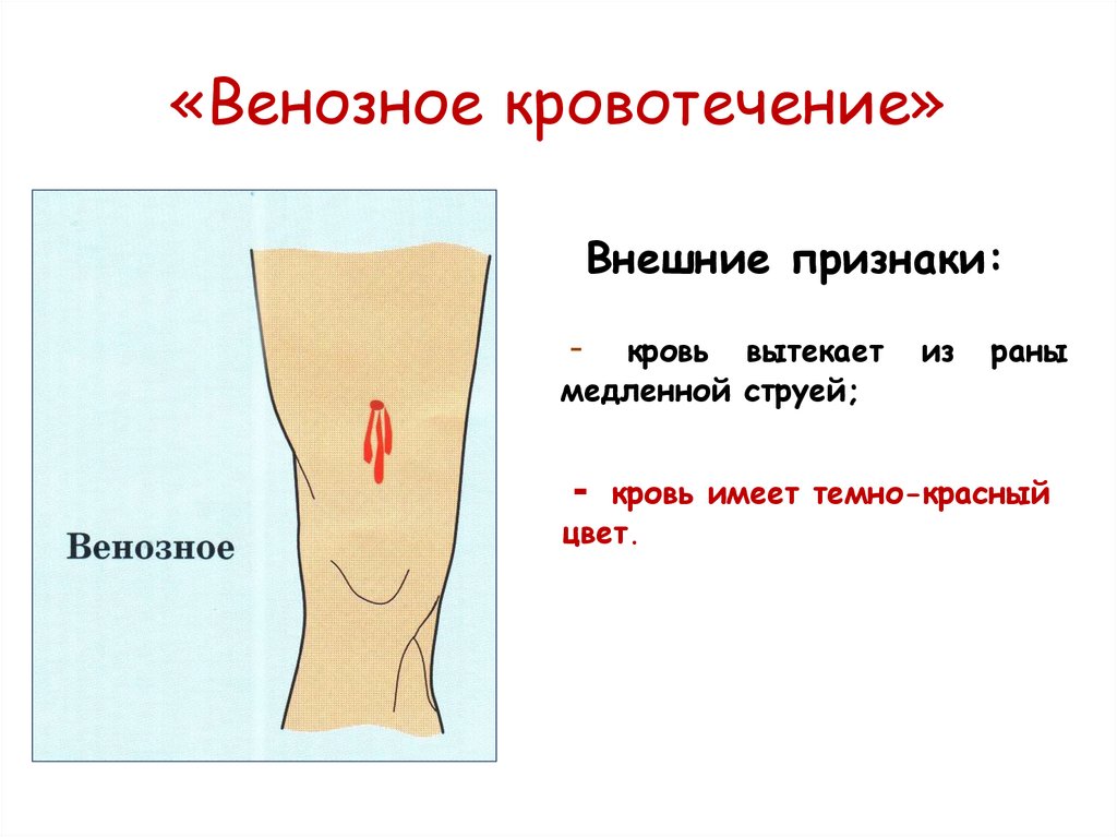 «Венозное кровотечение»
