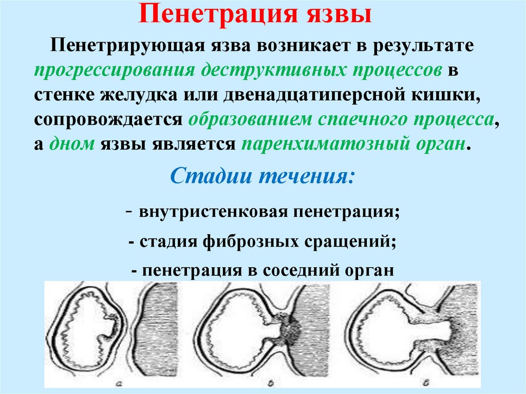 Пенетрация язвы