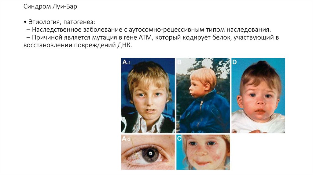 Синдром Луи-Бар • Этиология, патогенез: – Наследственное заболевание с аутосомно-рецессивным типом наследования. – Причиной