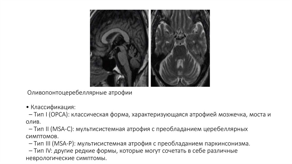 Оливопонтоцеребеллярные атрофии • Классификация: – Тип I (OPCA): классическая форма, характеризующаяся атрофией мозжечка, моста