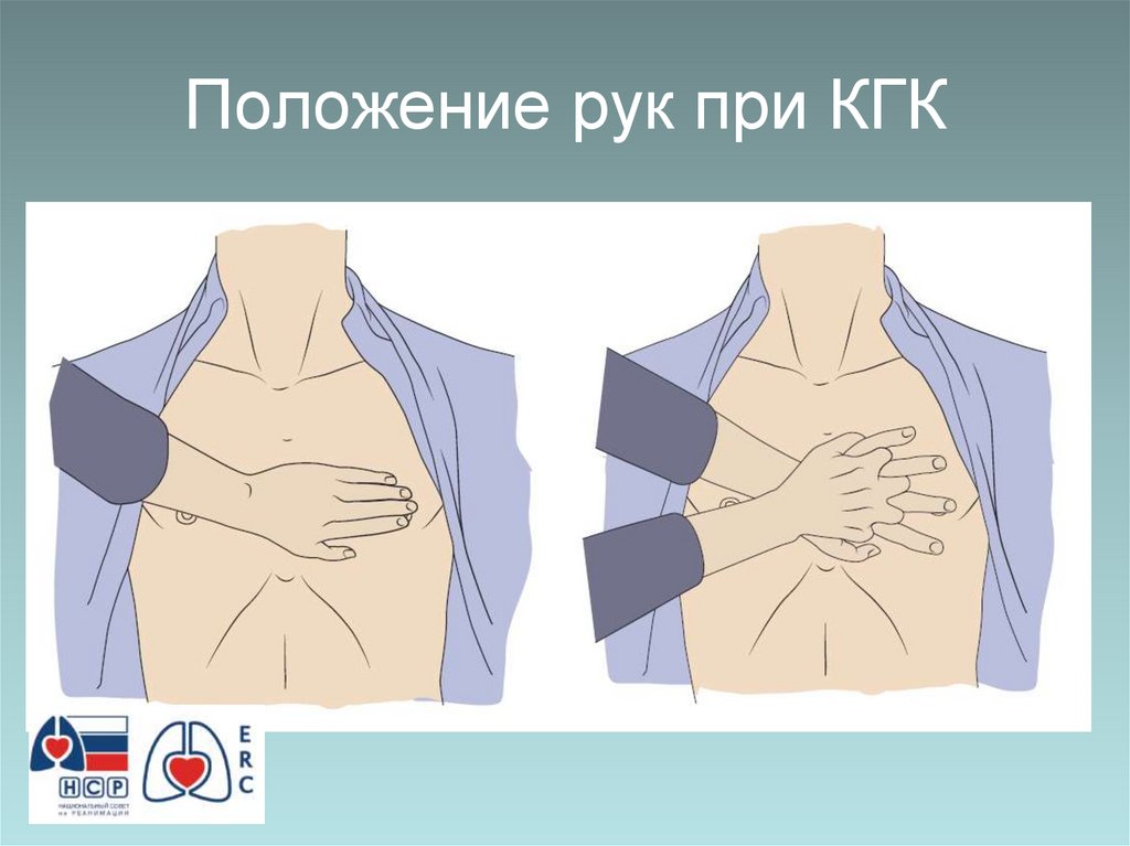 Положение рук при КГК