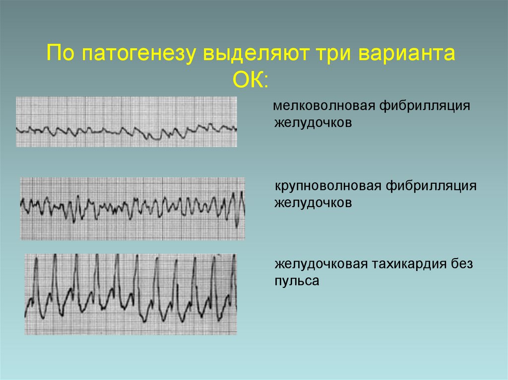 По патогенезу выделяют три варианта ОК: