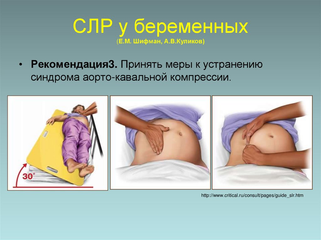 СЛР у беременных (Е.М. Шифман, А.В.Куликов)