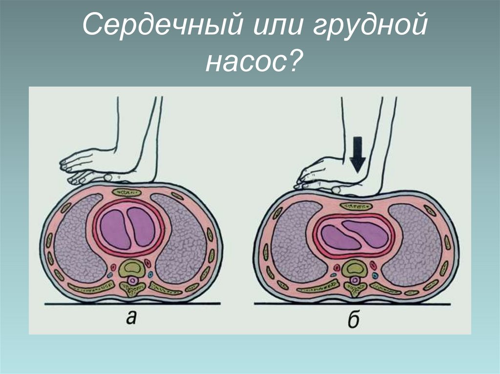 Сердечный или грудной насос?