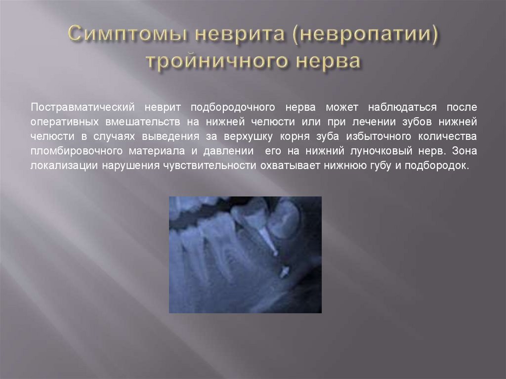 Симптомы неврита (невропатии) тройничного нерва