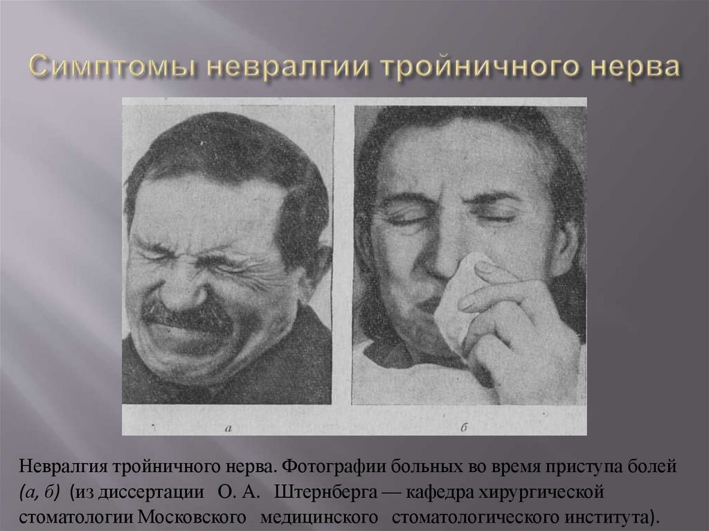 Симптомы невралгии тройничного нерва