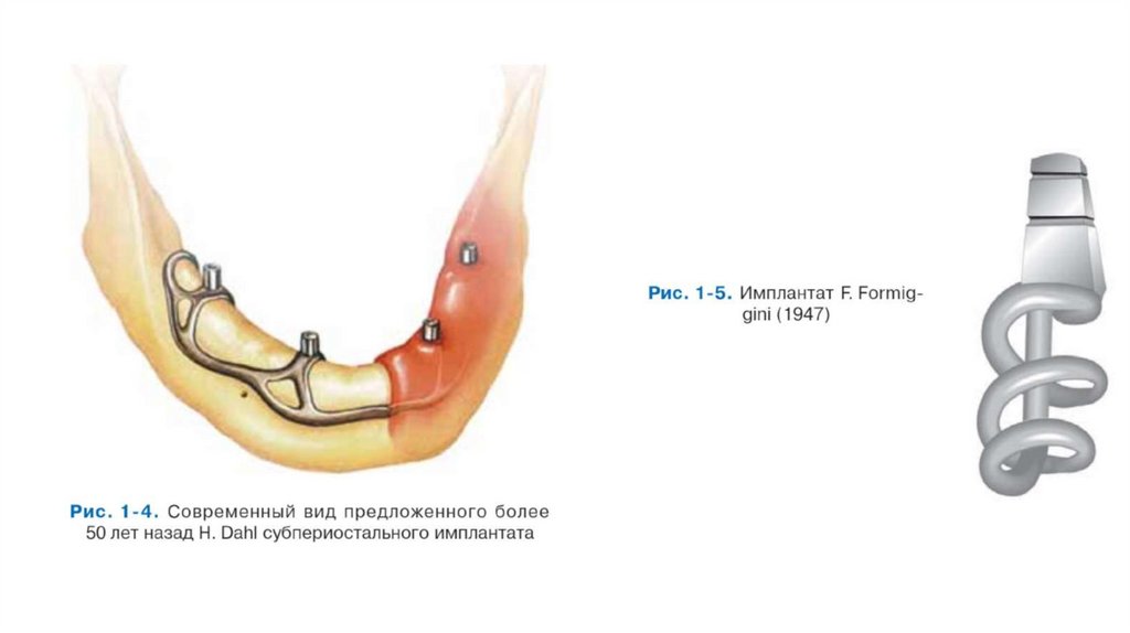 2-BOSQICH: FORMAL ILMIY URINISHLAR (1809–1930)Implantologiyaning tajriba bosqichidan ilmiy qarashlar bosqichiga o‘tgan poydevor