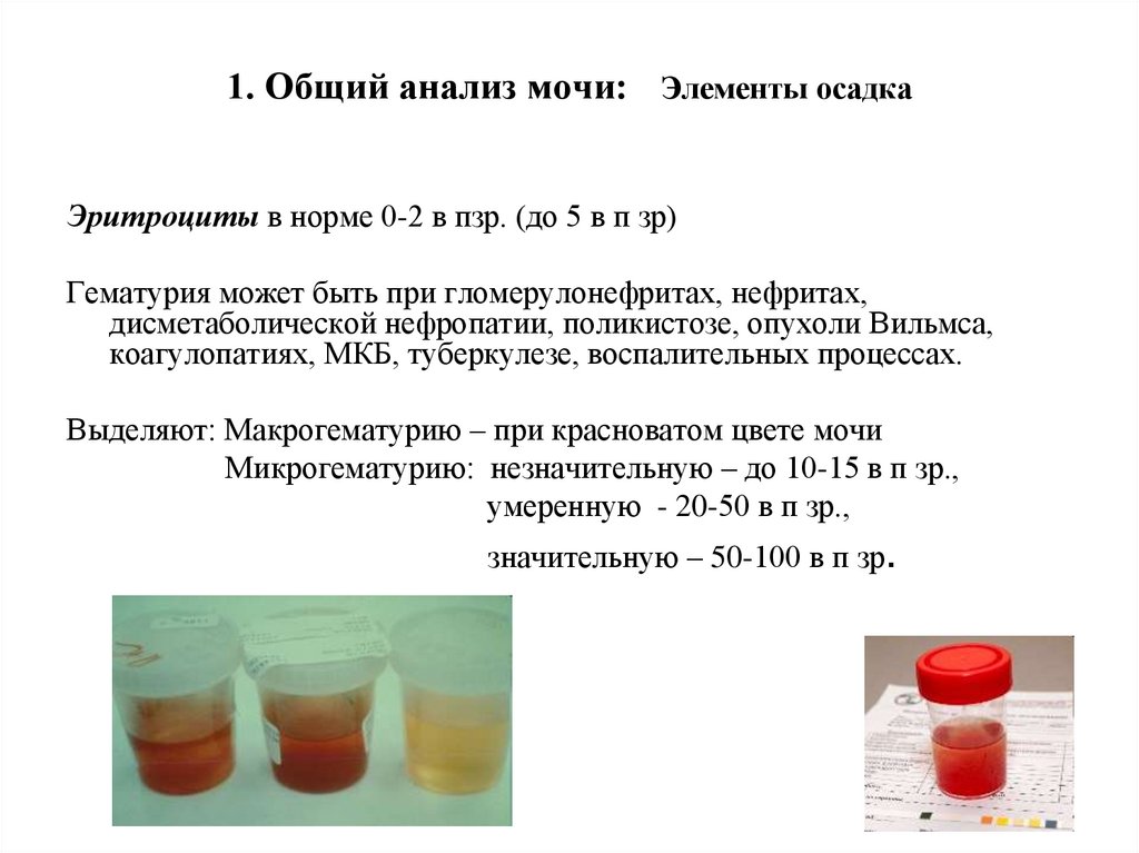 1. Общий анализ мочи: Элементы осадка