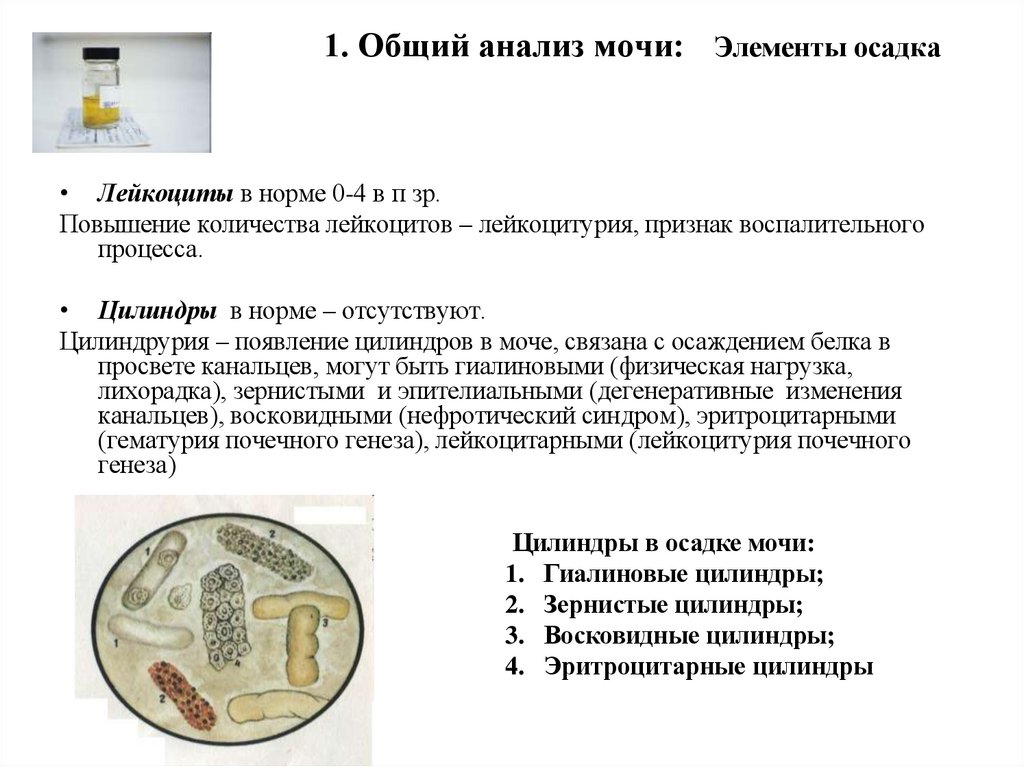 1. Общий анализ мочи: Элементы осадка