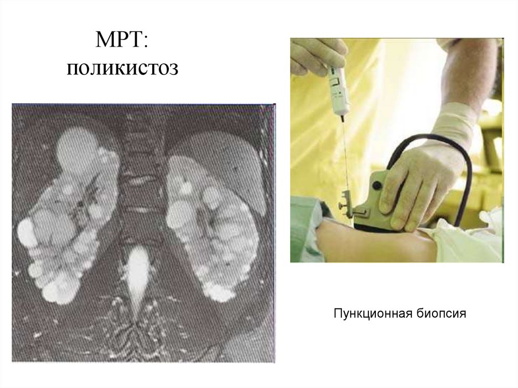 МРТ: поликистоз