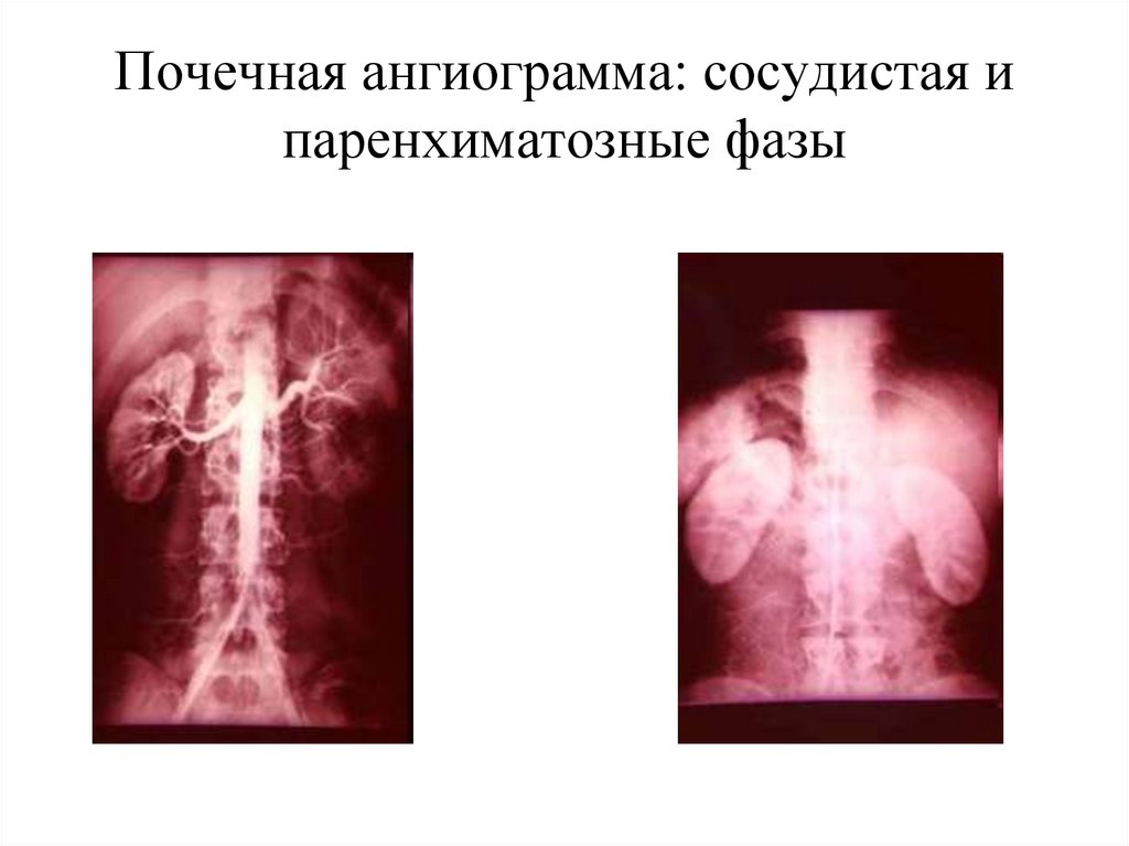 Почечная ангиограмма: сосудистая и паренхиматозные фазы