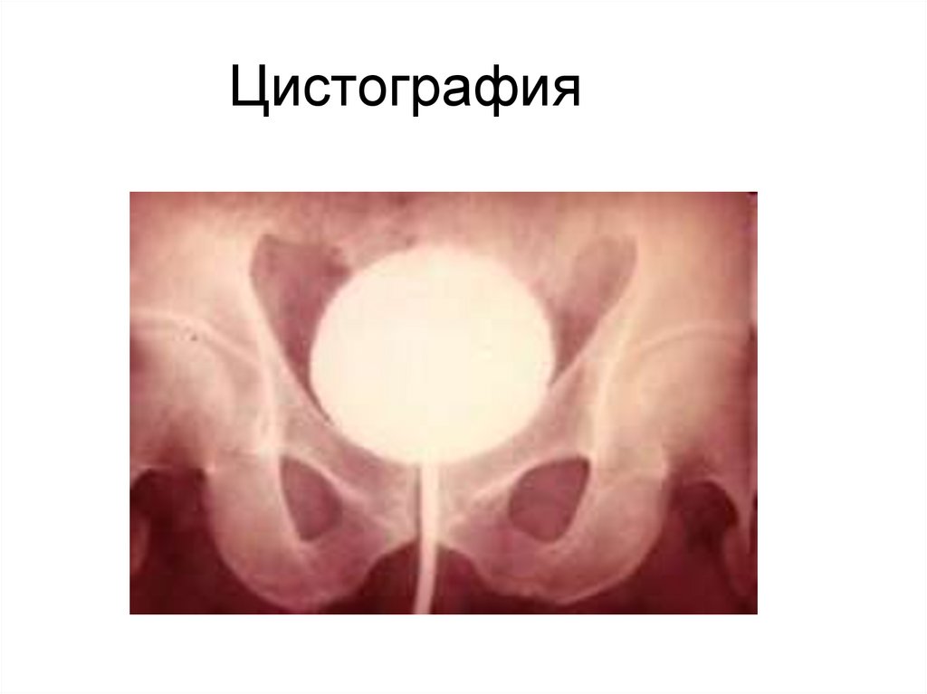 Цистография