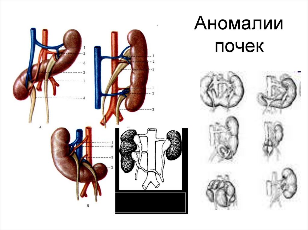 Аномалии почек